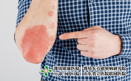 攝圖網_506432486_患有粗俗的牛皮癬濕疹和其他皮膚?。ㄆ髽I商用）