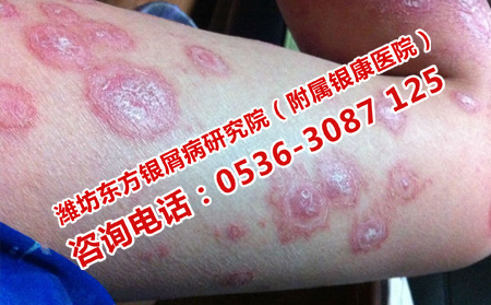 如何護(hù)理銀屑病患者的皮膚