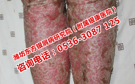 銀屑病的專業(yè)護(hù)理