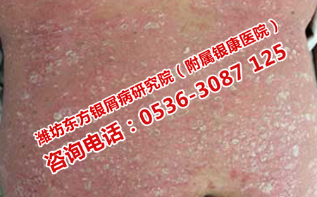 濰坊治療牛皮癬的醫(yī)院