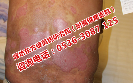 治療中牛皮癬復發怎么辦