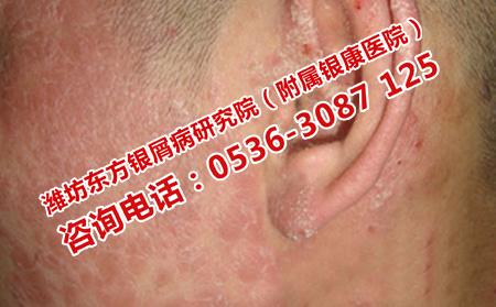 孩子得了牛皮癬應該怎么護理