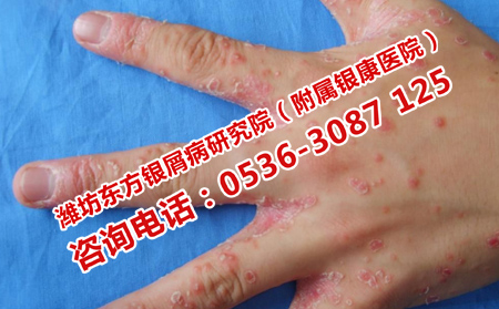 控制牛皮癬擴(kuò)散的辦法
