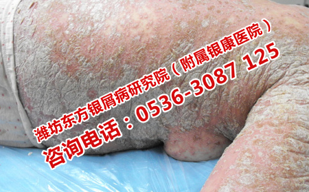 哪家醫院治牛皮癬有效