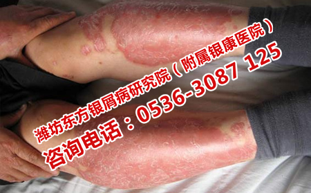 預(yù)防牛皮癬短期復(fù)發(fā)的方法