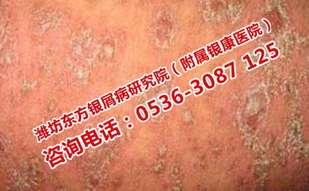 如何規(guī)避牛皮癬