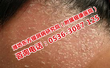 如何預防牛皮癬再三發作