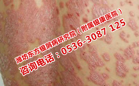 濰坊治療銀屑病的?？漆t(yī)院