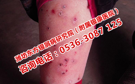 濰坊銀屑病醫(yī)院治療費(fèi)
