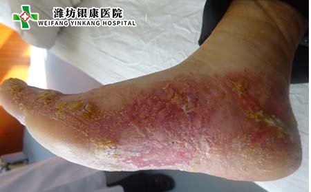 神經(jīng)性牛皮癬是什么?