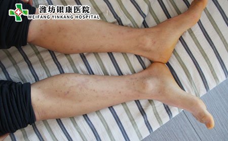 濰坊牛皮癬醫(yī)院：牛皮癬遺傳怎么辦?